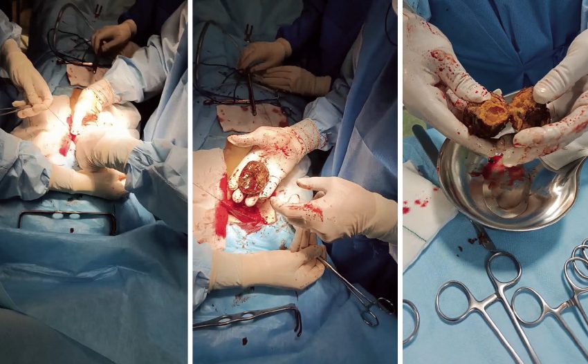  ماجرای وحشتناک «خرمالو» در اتاق های عمل!